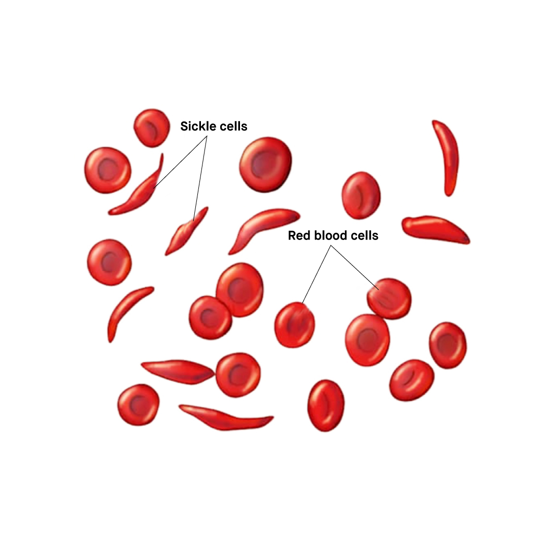 Is sickle cell disease common