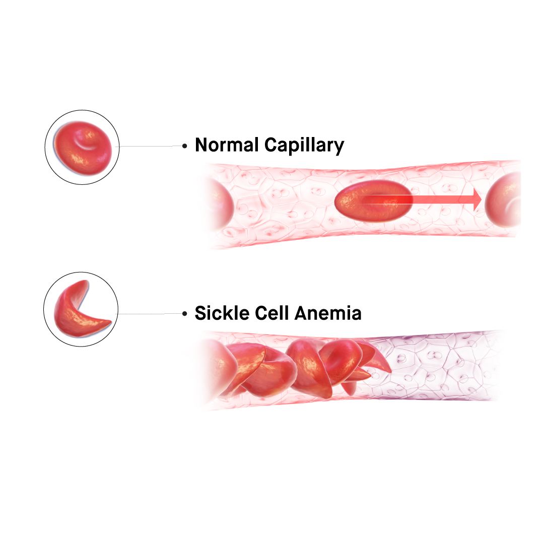 What are some of the efforts for raising awareness for sickle cell disease