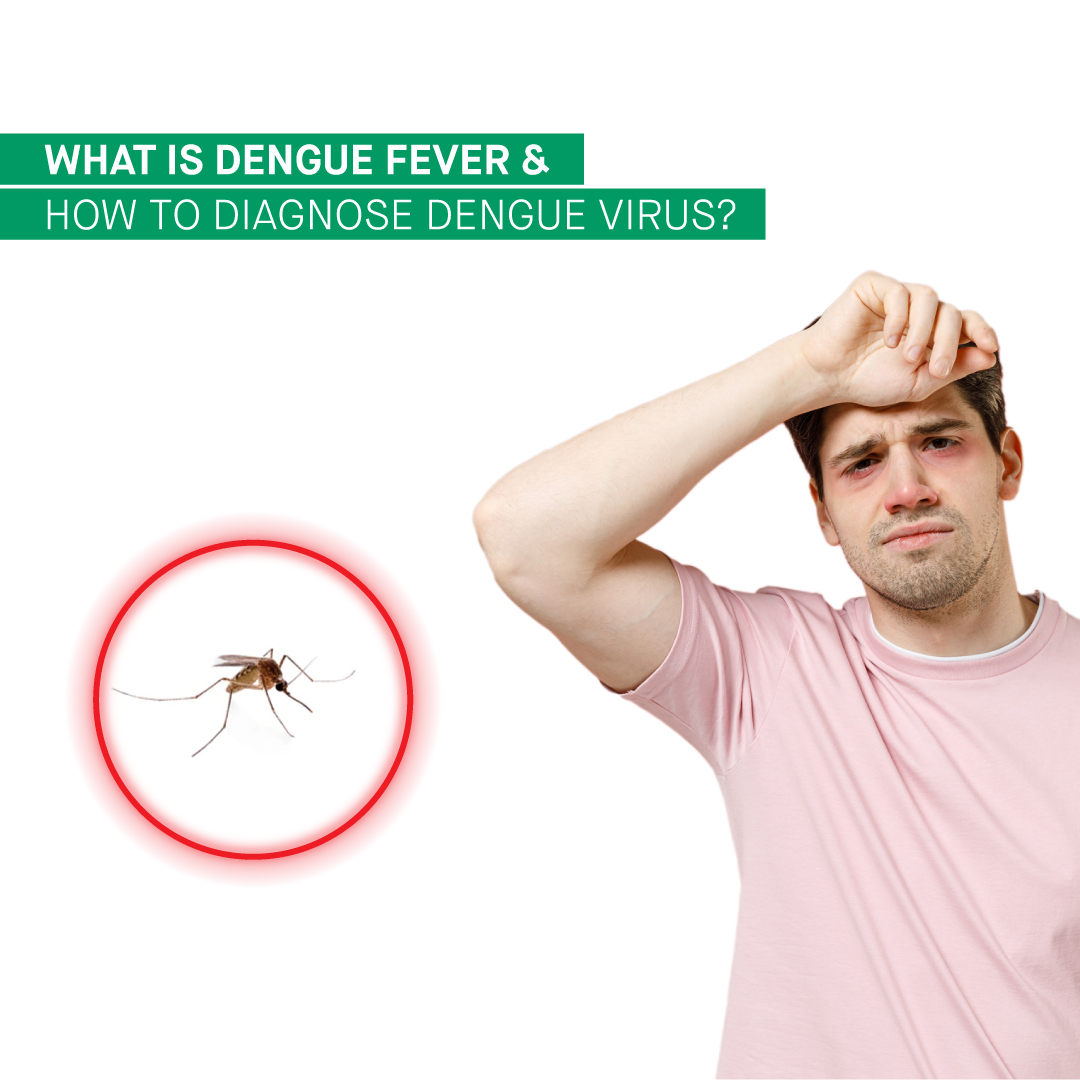 What is Dengue Fever and How to Diagnose Dengue Virus