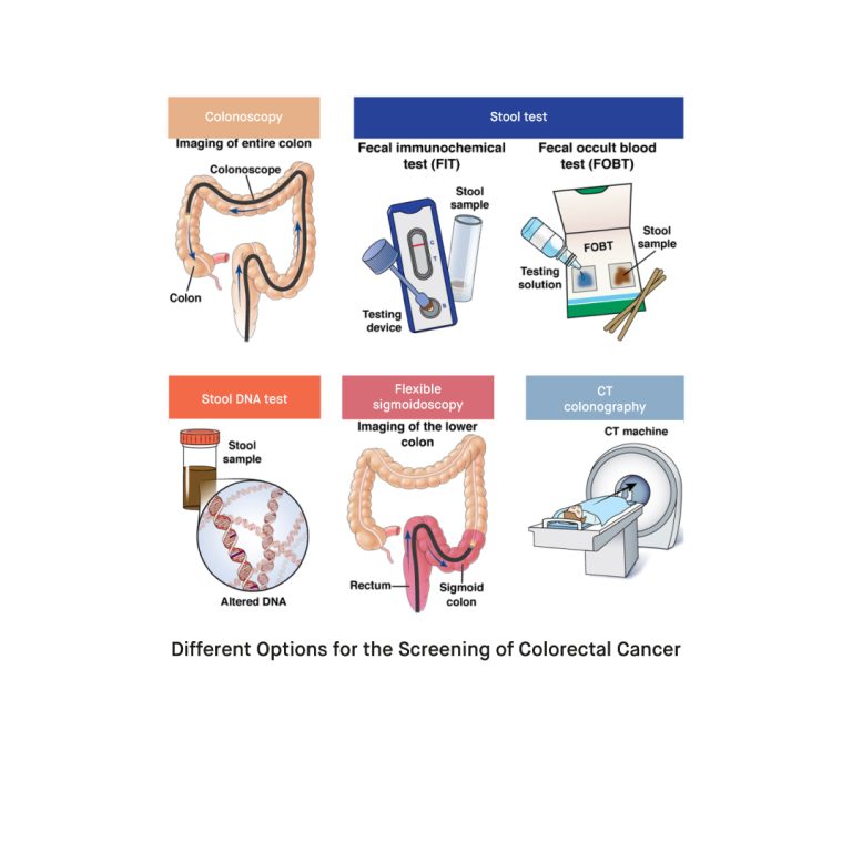 What Is Bowel Cancer and How to Use a Home Test Kit for Bowel Cancer ...