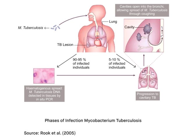 What Causes Tuberculosis TB 2