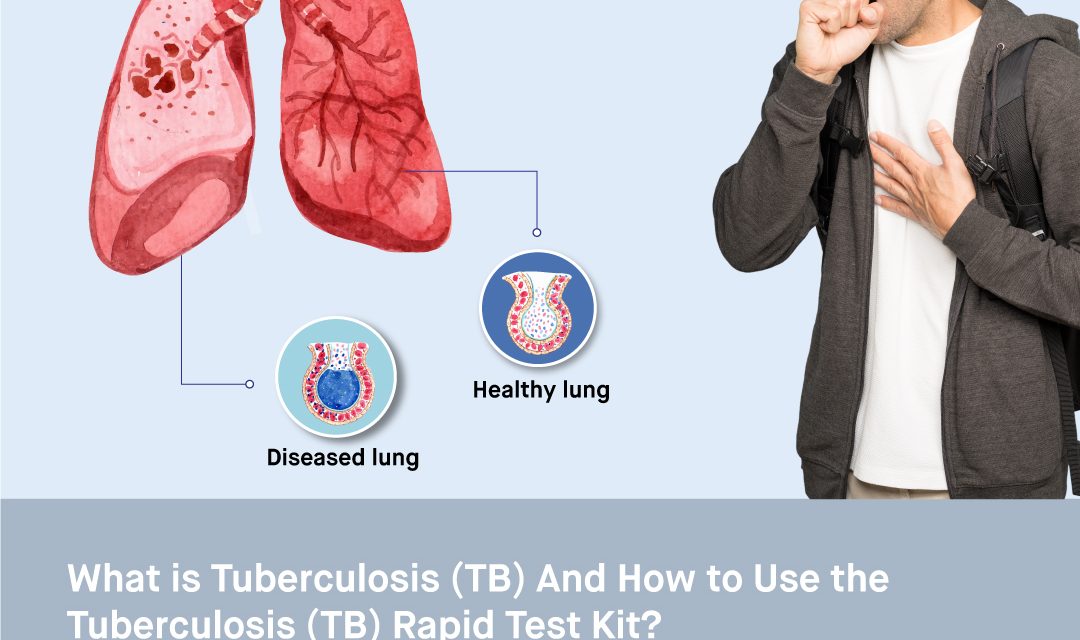 What is Tuberculosis (TB) and How to Use the Tuberculosis (TB) Rapid Test Kit?