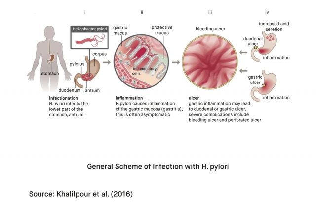 What is Helicobacter Pylori H. pylori 2