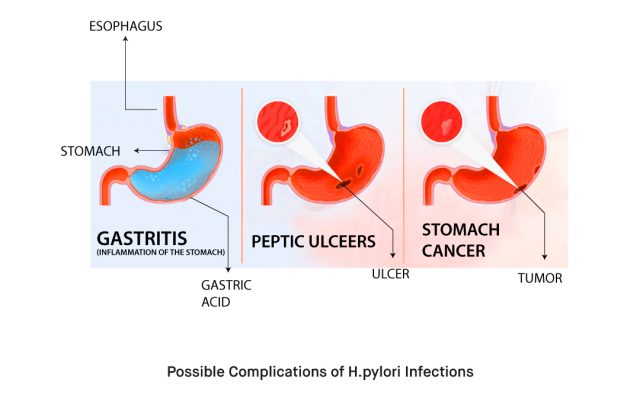 What is Helicobacter Pylori H. pylori and How to Use the H. pylori Rapid Test Kit 3