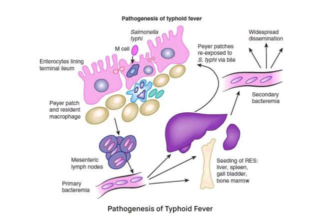 What is Typhoid Fever