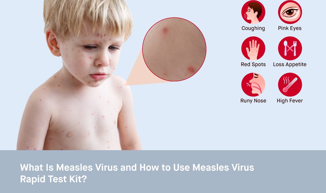 What is Measles Virus and How to Use Measles Virus Rapid Test Kit?