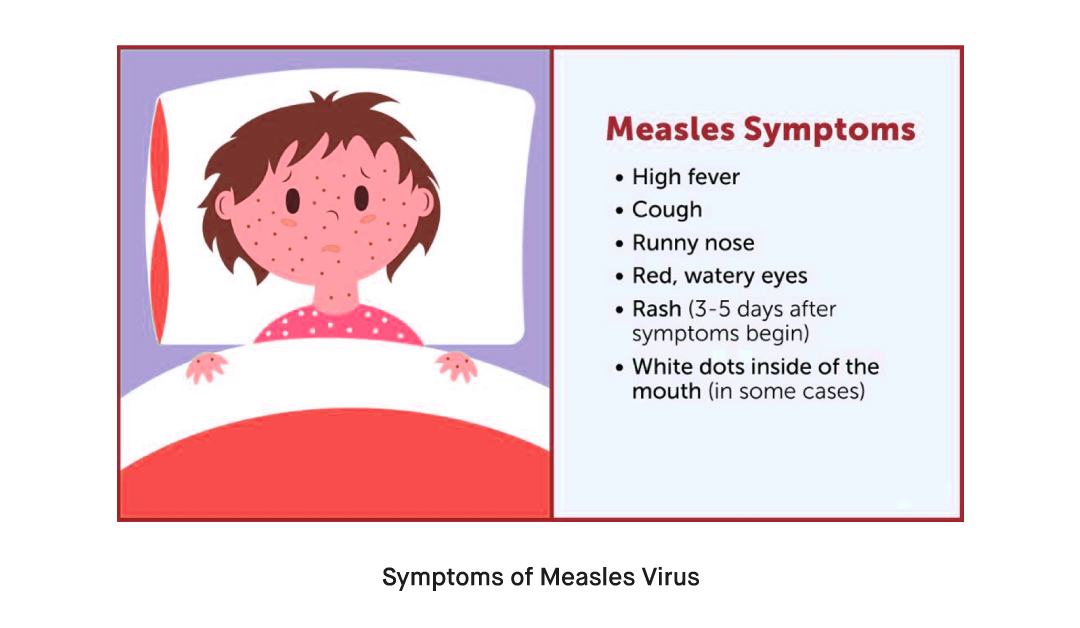 What are the Symptoms of Measles