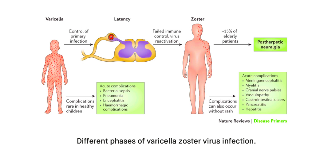 How to Diagnose Varicella Zoster Virus