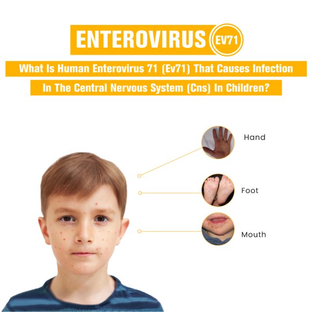 What is Human Enterovirus 71 EV71 That Causes Infection in the Central Nervous System CNS in Children How to Use Enterovirus 71 IgM Rapid Test Kit