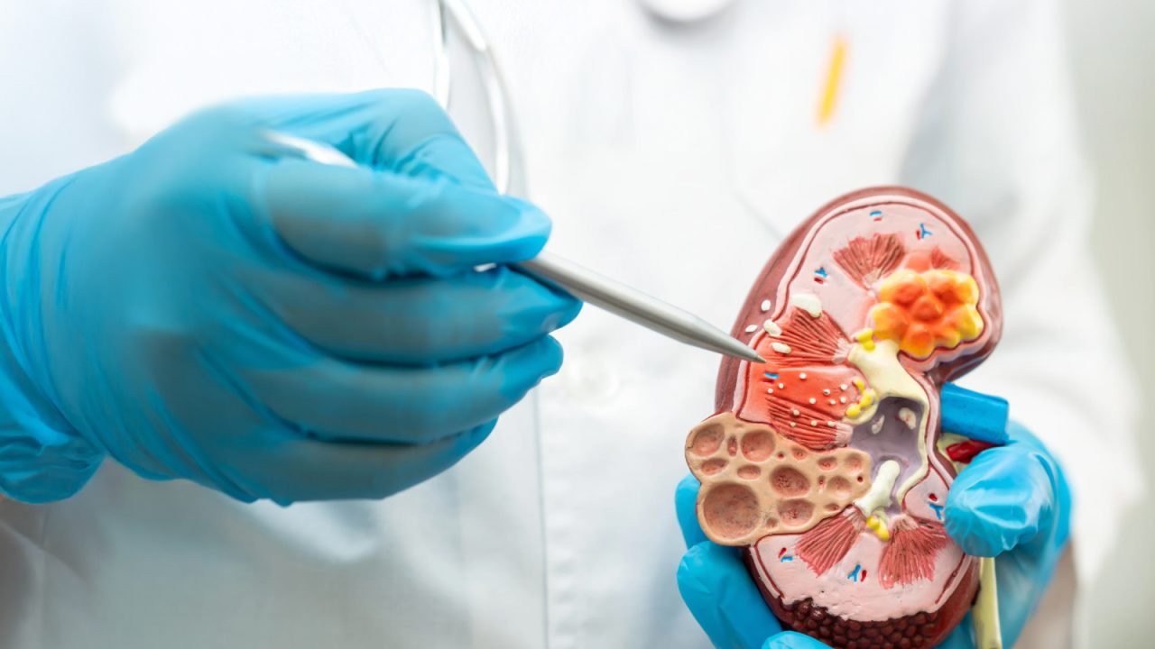 Protect Your Kidney Health: Early Diagnosis & UTI Prevention