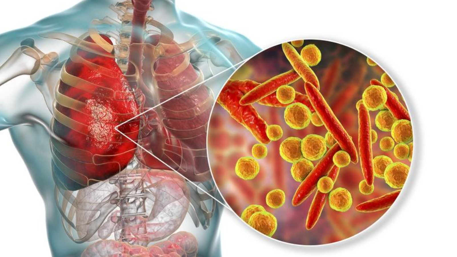 Figure1. Visualization of bacterial infection in the lungs, illustrating the impact of Mycoplasma pneumoniae on the respiratory system.
