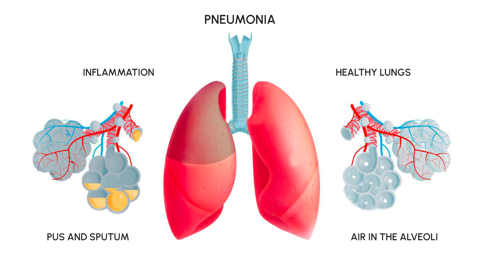 Figure2. Diagram comparing healthy lungs with pneumonia-affected lungs, showing inflammation, pus, and fluid accumulation in the alveoli.