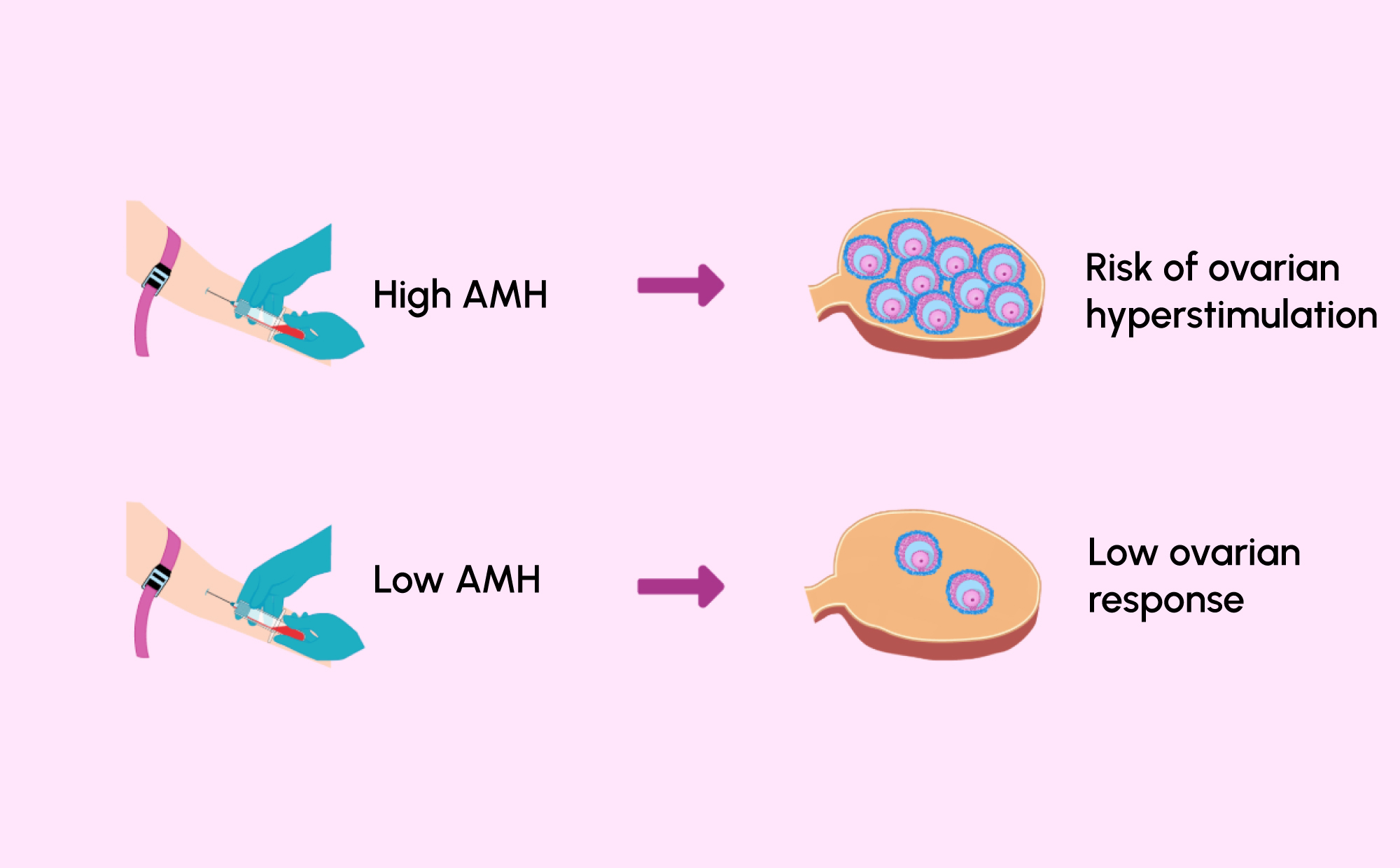 Discover AMH Testing: Ovarian Reserve, PCOS and Fertility 1 Figure 1: Relationship between AMH levels and expected ovarian response during fertility treatment.