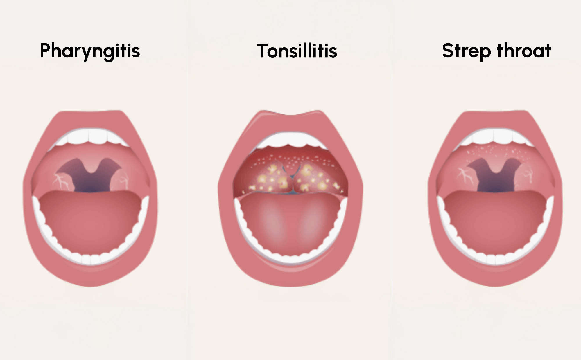 Strep A Testing in the Evaluation of Streptococcal Pharyngitis 1 Figure 1. Illustrative comparison of pharyngitis, tonsillitis, and strep throat, showing possible differences in throat and tonsil appearance.